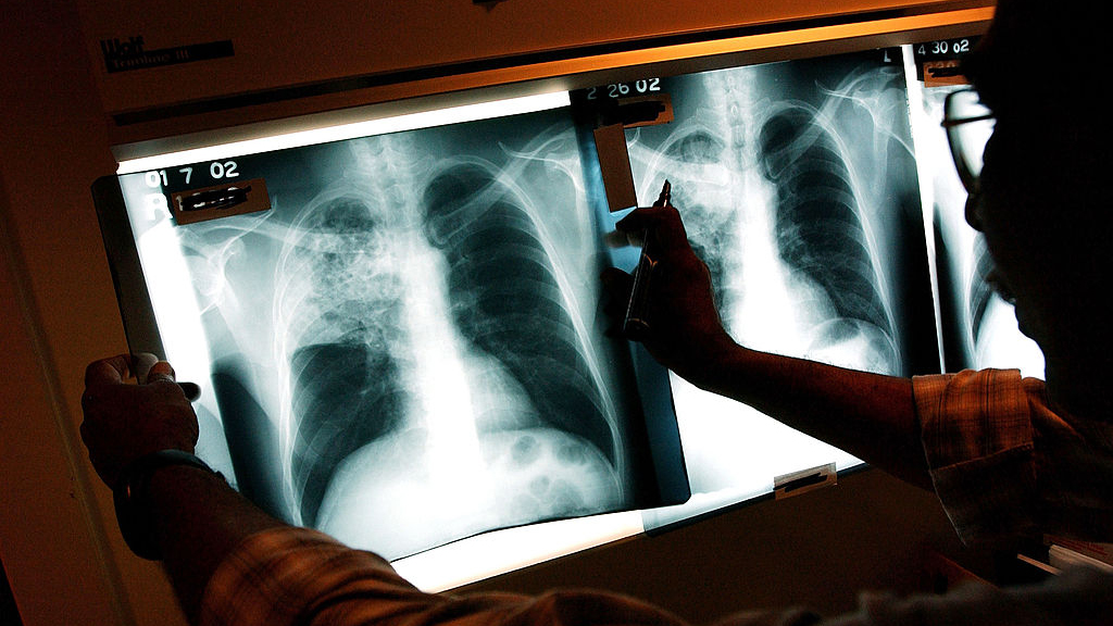 2 active tuberculosis cases traced to San Francisco strip club — KTVU FOX 2 Bay Area, Hillsborough Health news